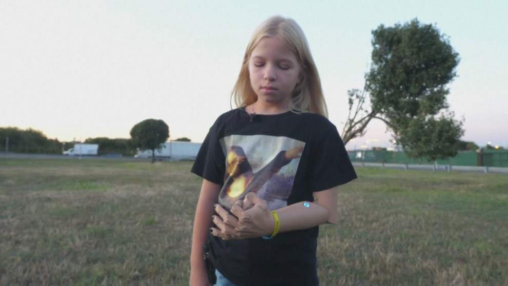 Alexandra sa učí s protézou plnohodnotne žiť