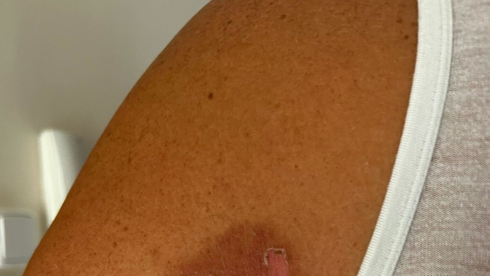 Miazga v spojení so slnkom spôsobila nepríjemné zranenia.