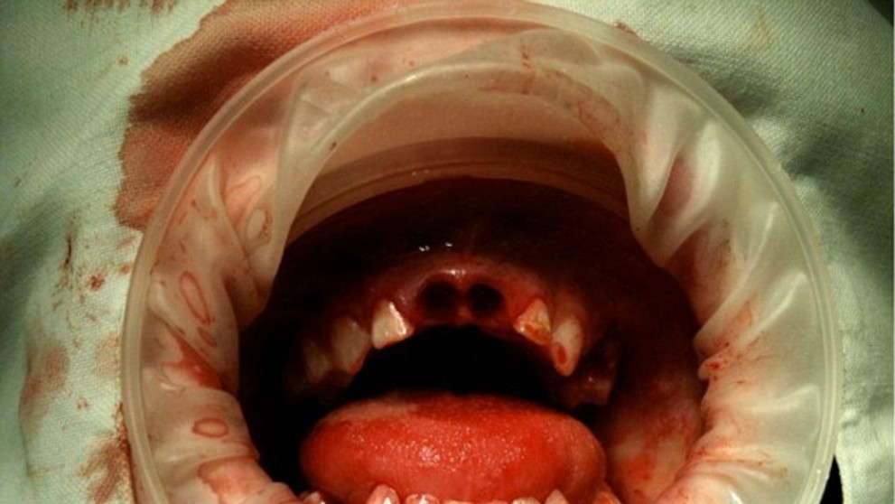 Deťom musia trhať mliečne zuby čoraz častejšie.