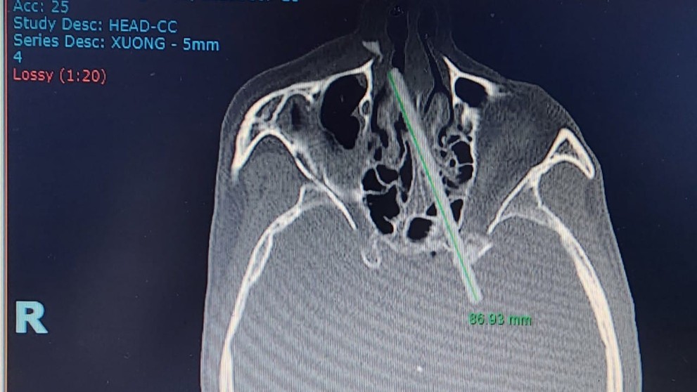Röntgenová snímka lebky.