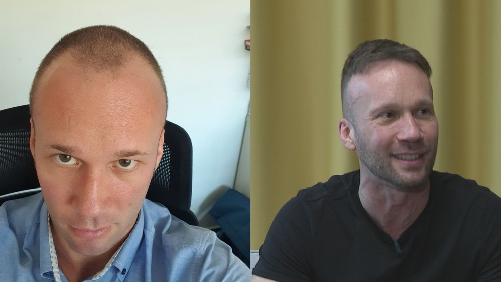 Roman pred (vľavo) a po zákroku.