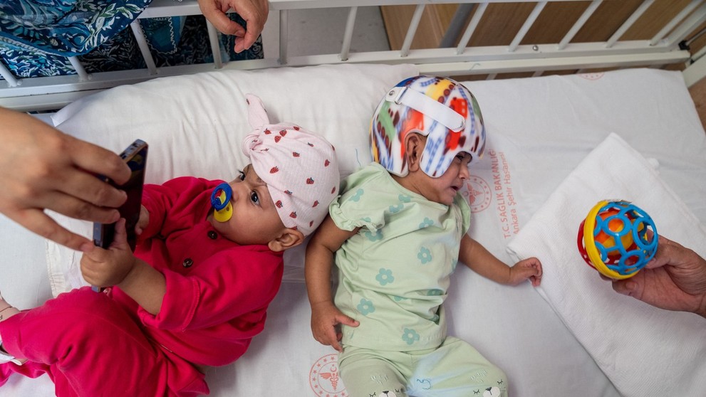 Dvojičky sa narodili so spojenými hlavami.