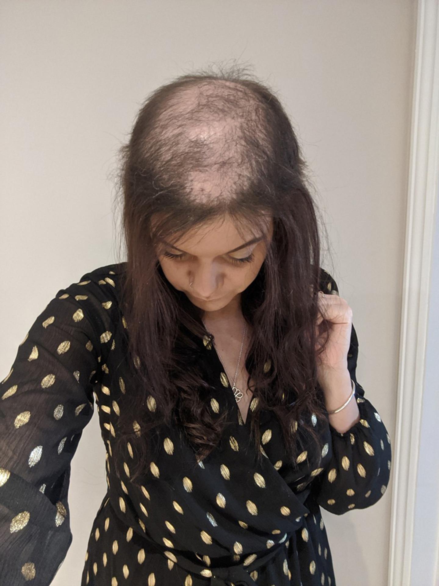 Hattie Gilford si vlasy trhala aj keď bola malé dievča.