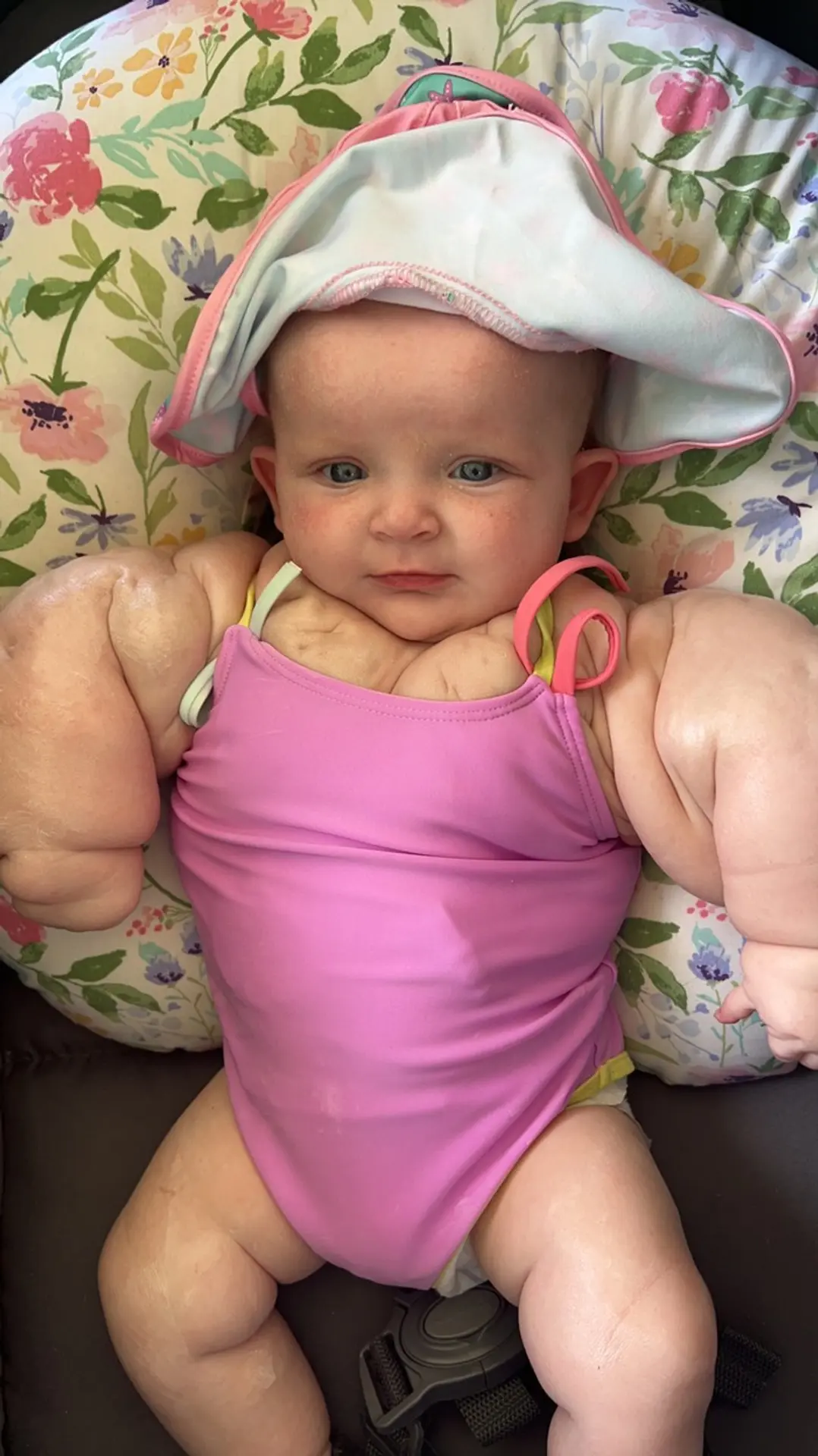  Armani Milbyová sa narodila so vzácnou genetickou poruchou.