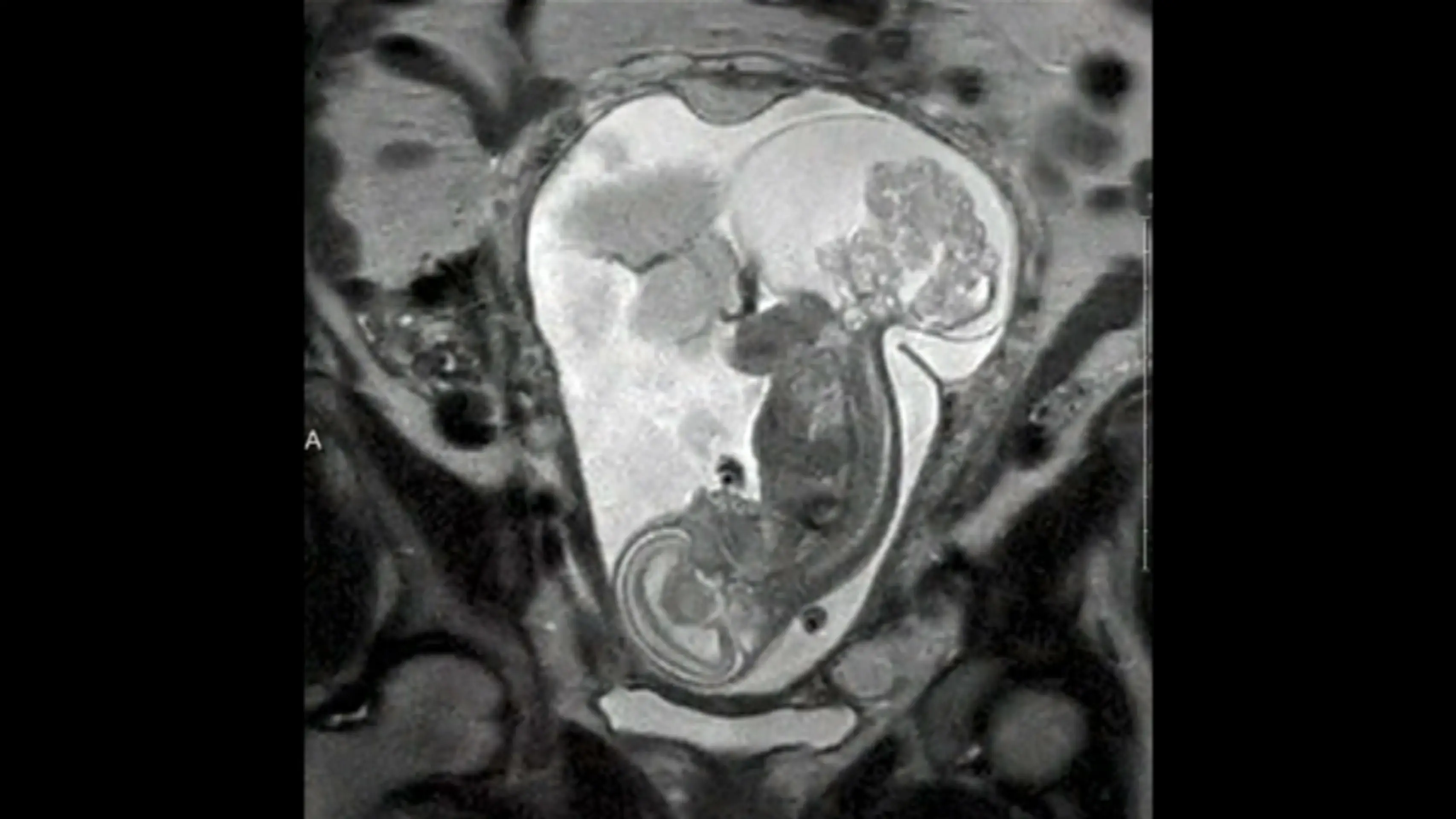 Dieťa a tumor