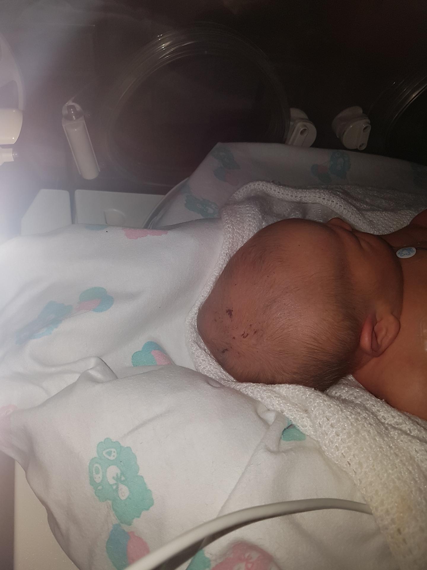 Hlavička malej Izabelke po páde veľmi opuchla.