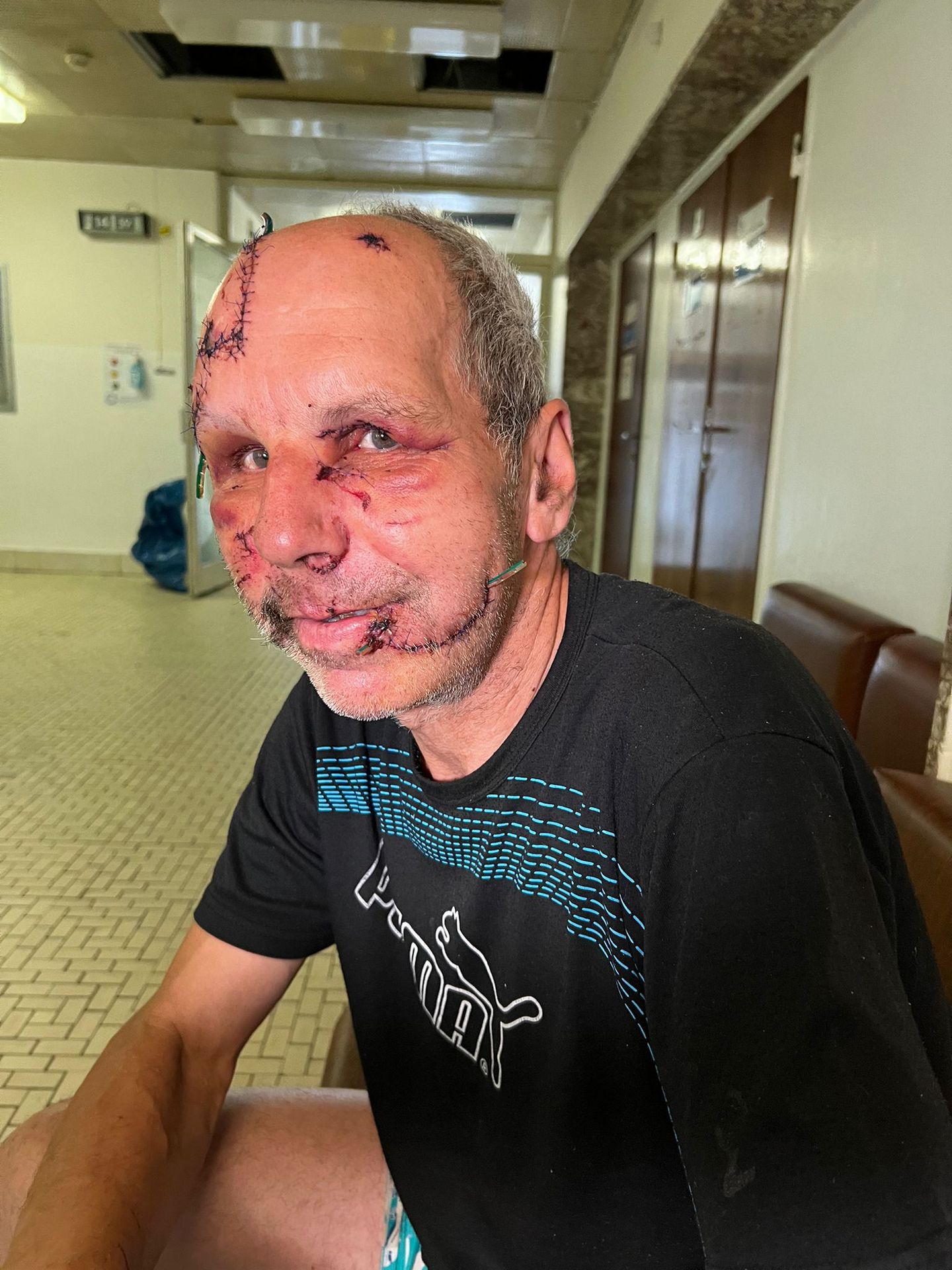 Napadnutý muž utrpel zranenia v oblasti hlavy a tváre