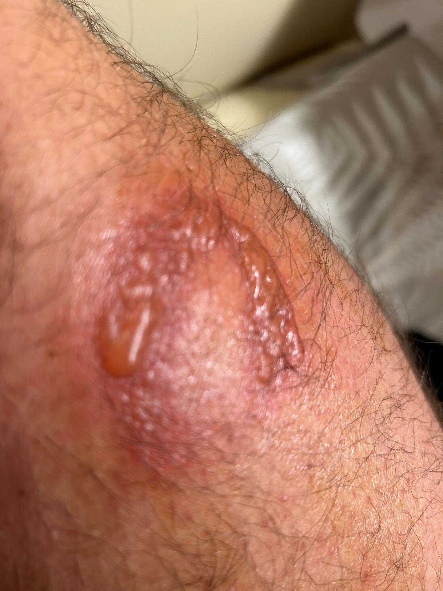 Miazga v spojení so slnkom spôsobila nepríjemné zranenia.