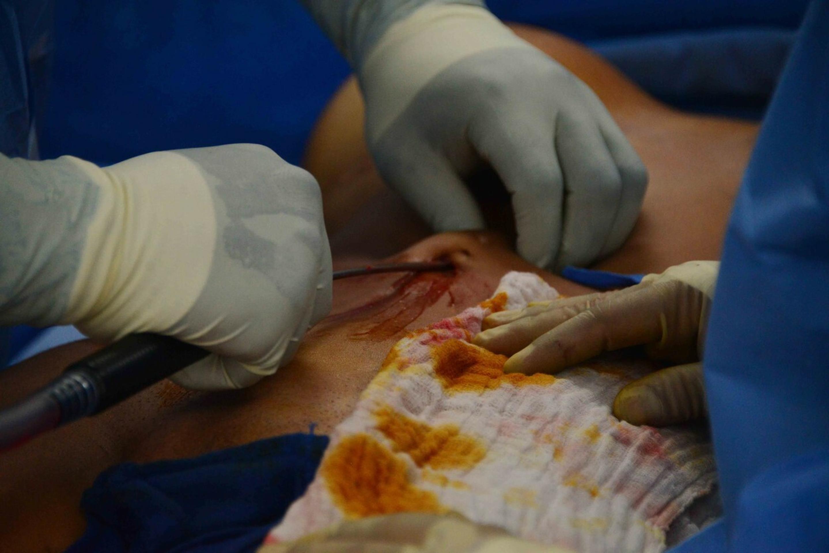 Nemecká sexbomba ukázala, ako jej vylepšovali brucho a zadok