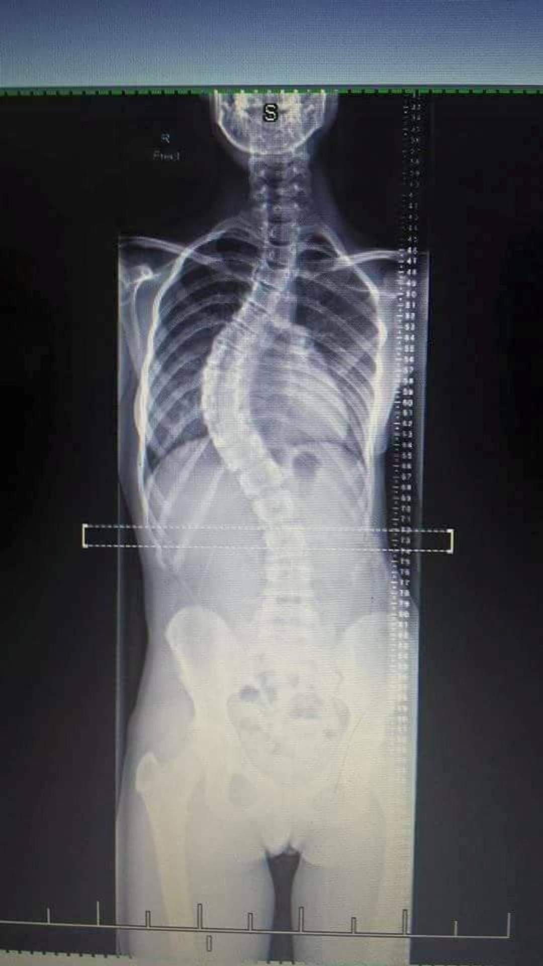 Sam Hansen a röntgen jej chrbtice.