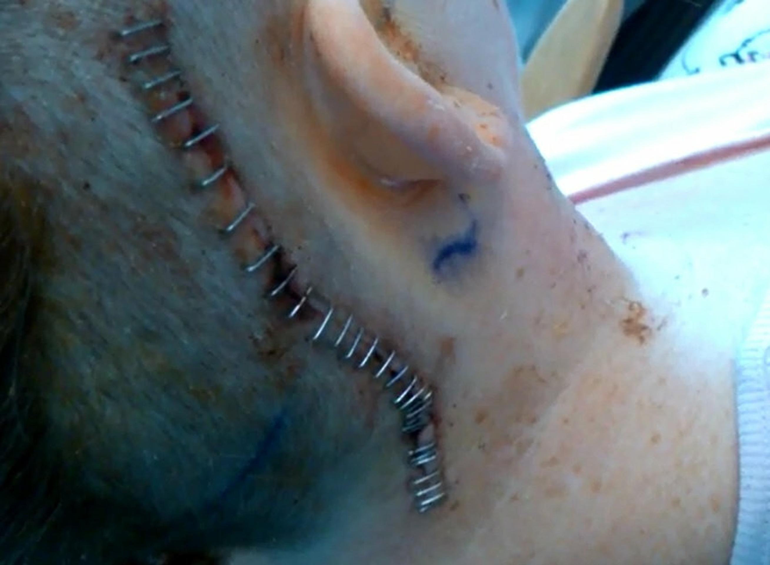 Jayne Reffin po operácii.