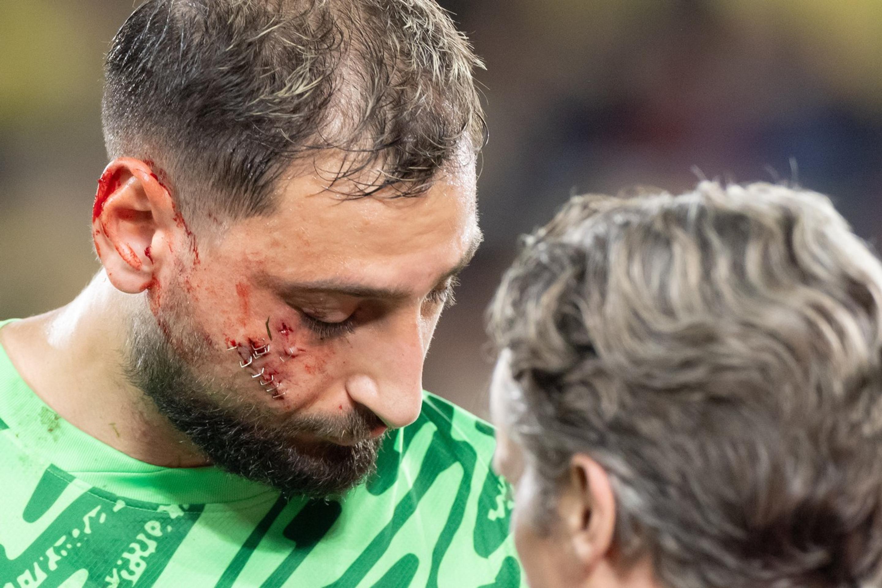 Gianluigi Donnarumma utrpel krvavé zranenie tváre.