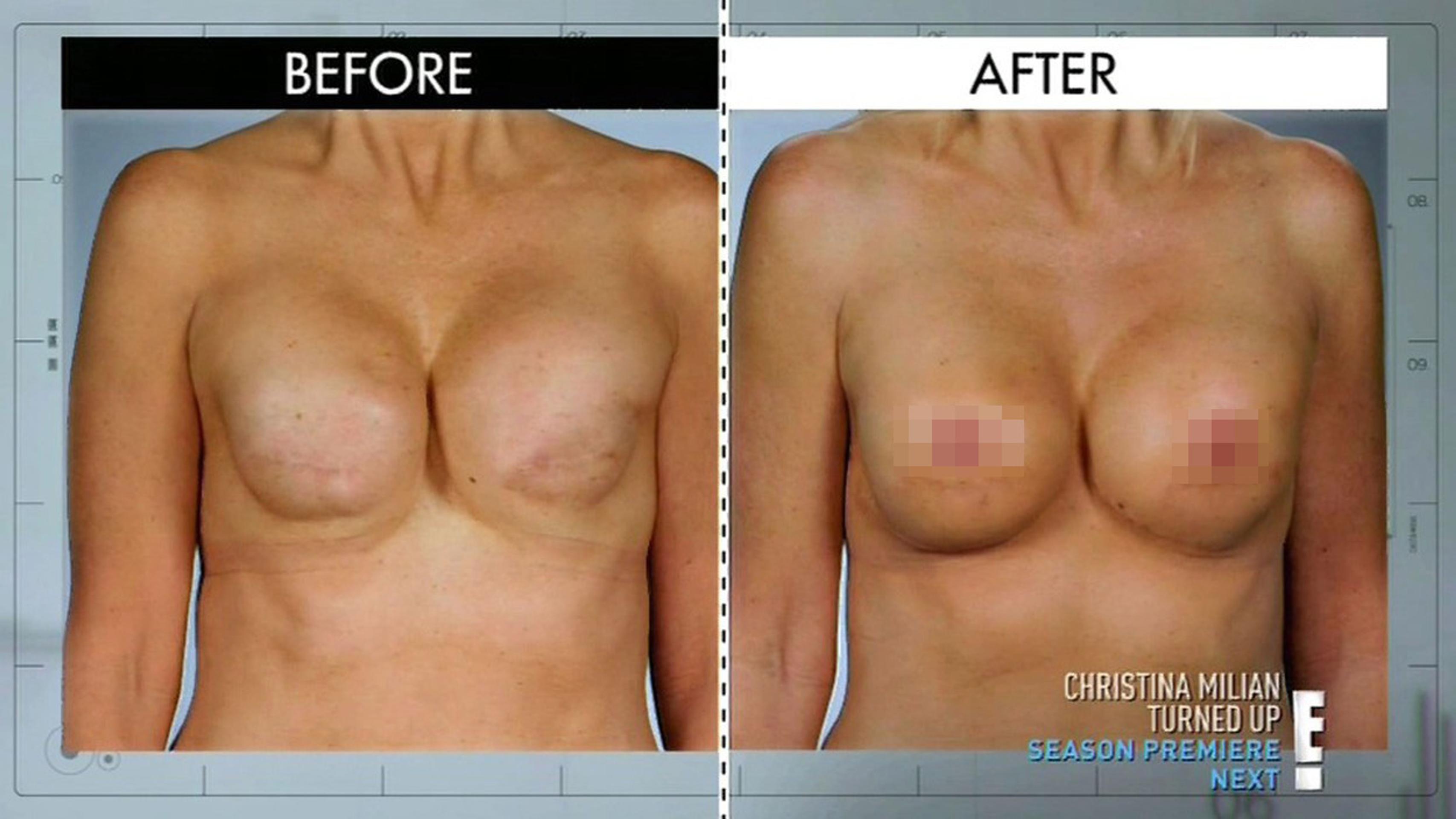 PRED a PO druhej rekonštrukcii. 