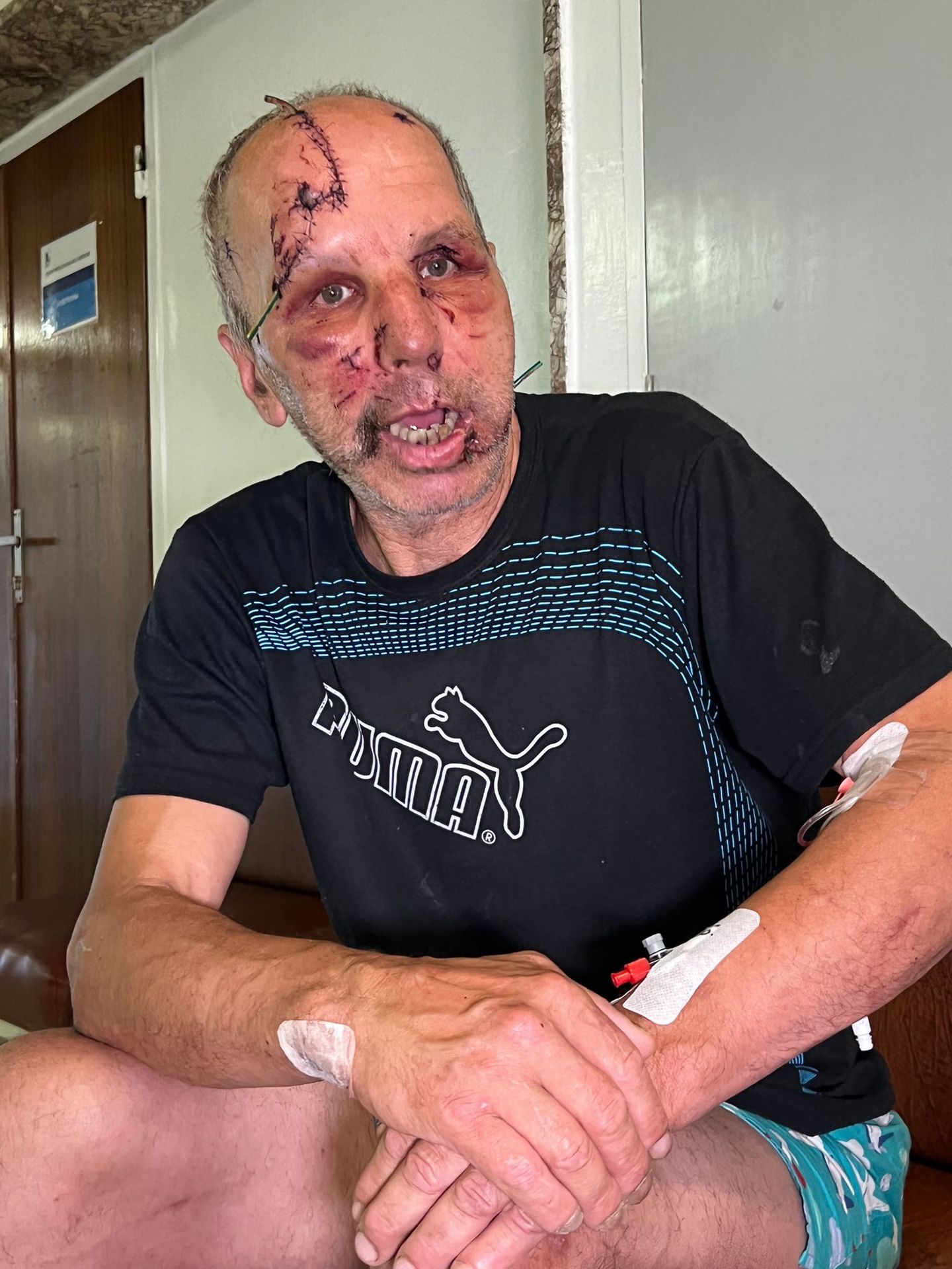 Zranenia utrpel v oblasti tváre - pera, čelo a temeno hlavy.