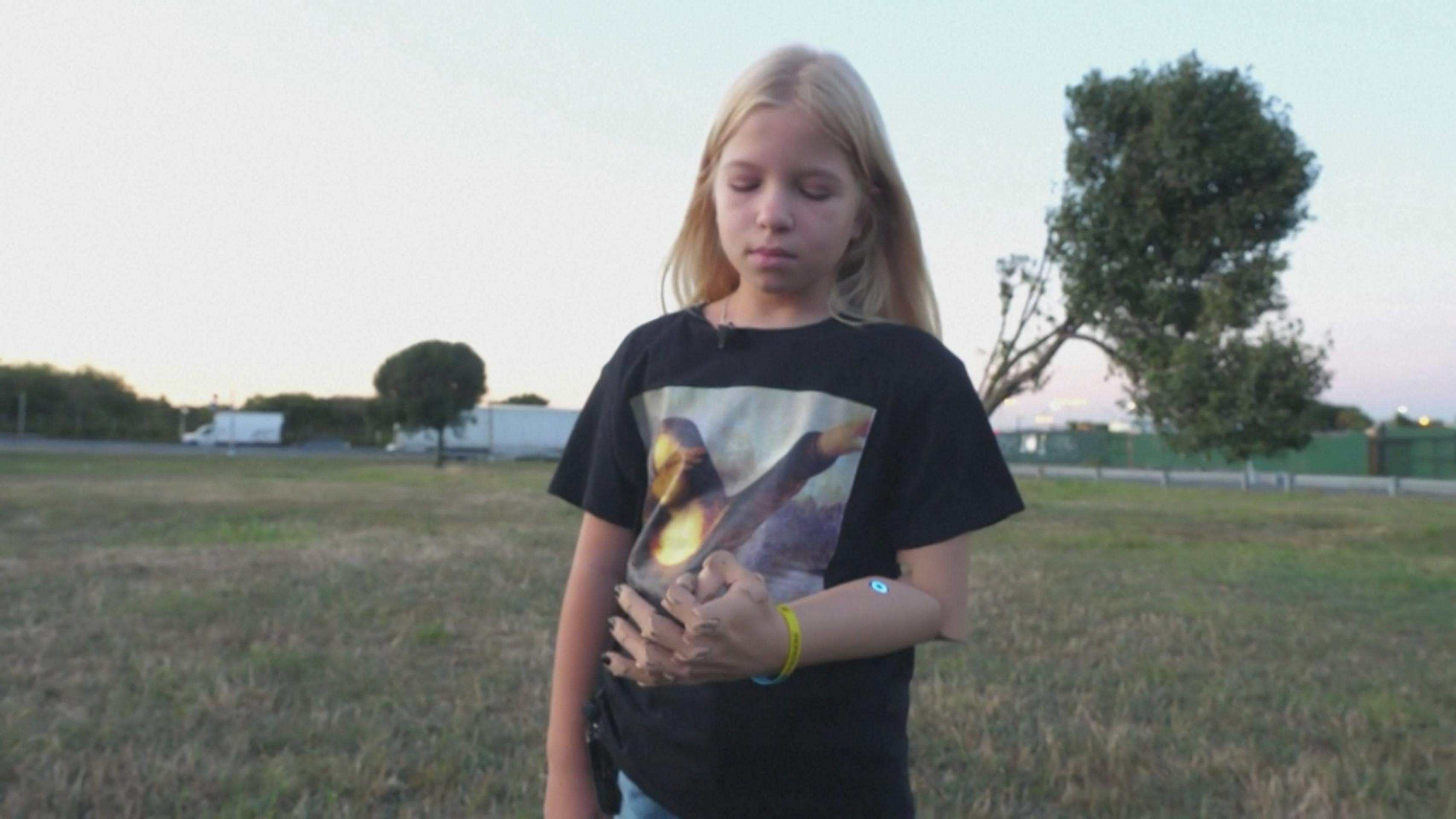 Alexandra sa učí s protézou plnohodnotne žiť