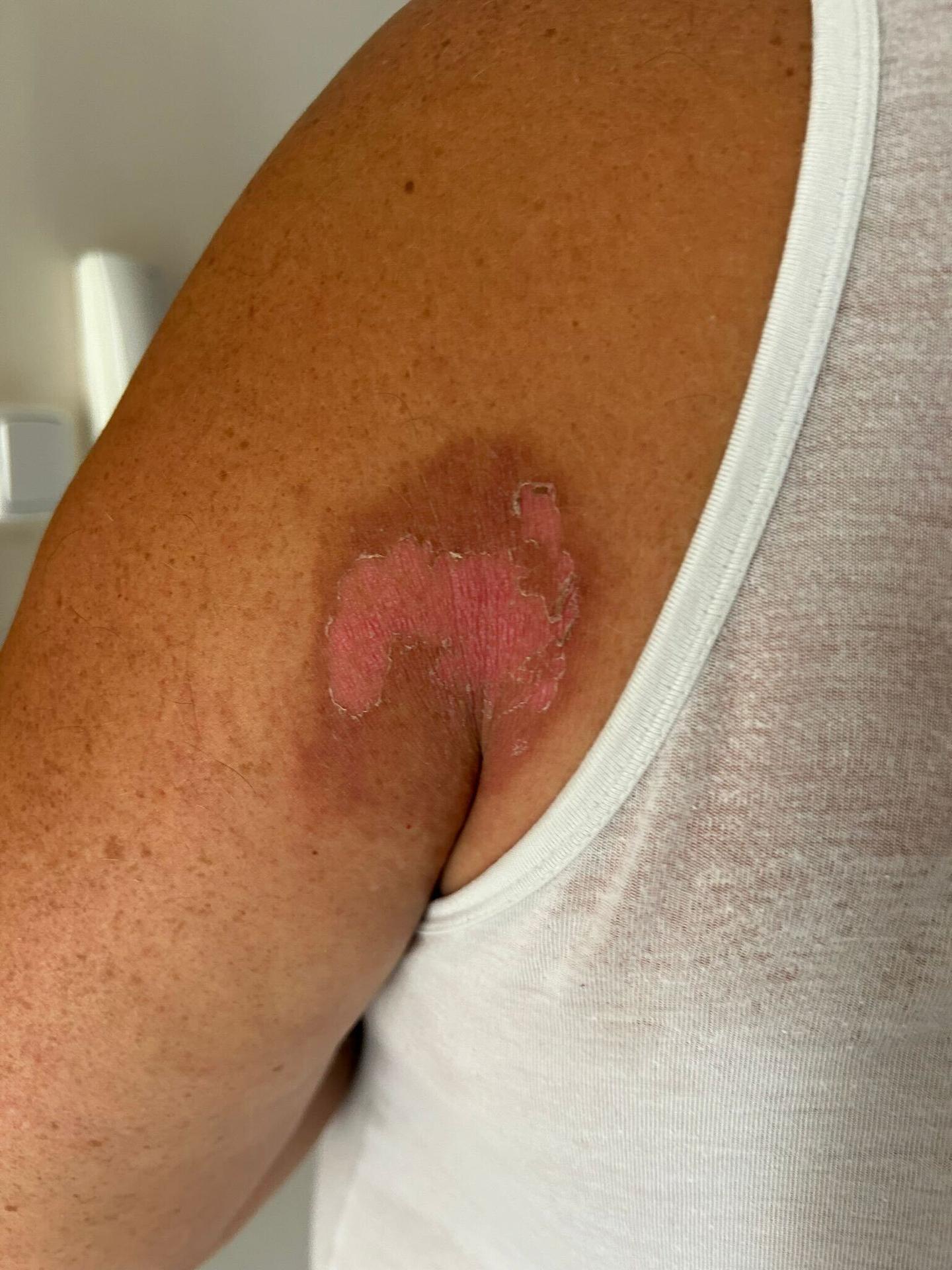 Miazga v spojení so slnkom spôsobila nepríjemné zranenia.