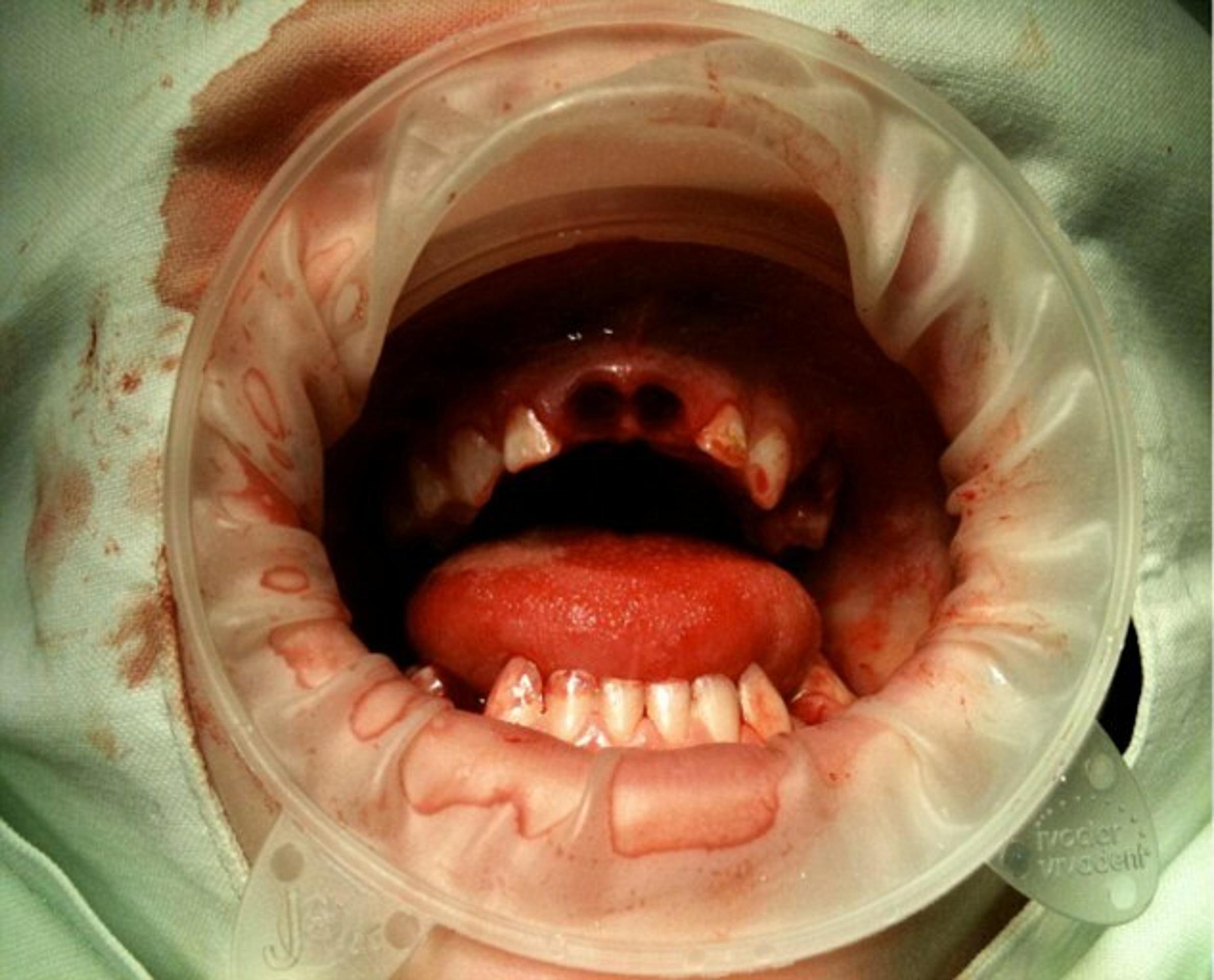 Deťom musia trhať mliečne zuby čoraz častejšie.