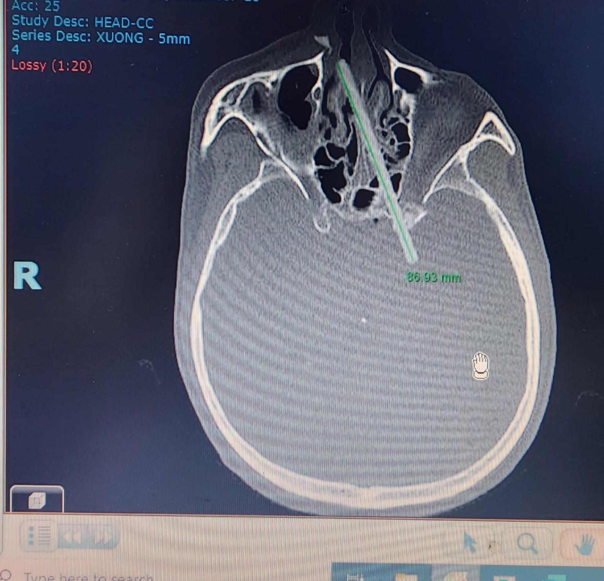 Röntgenová snímka lebky.