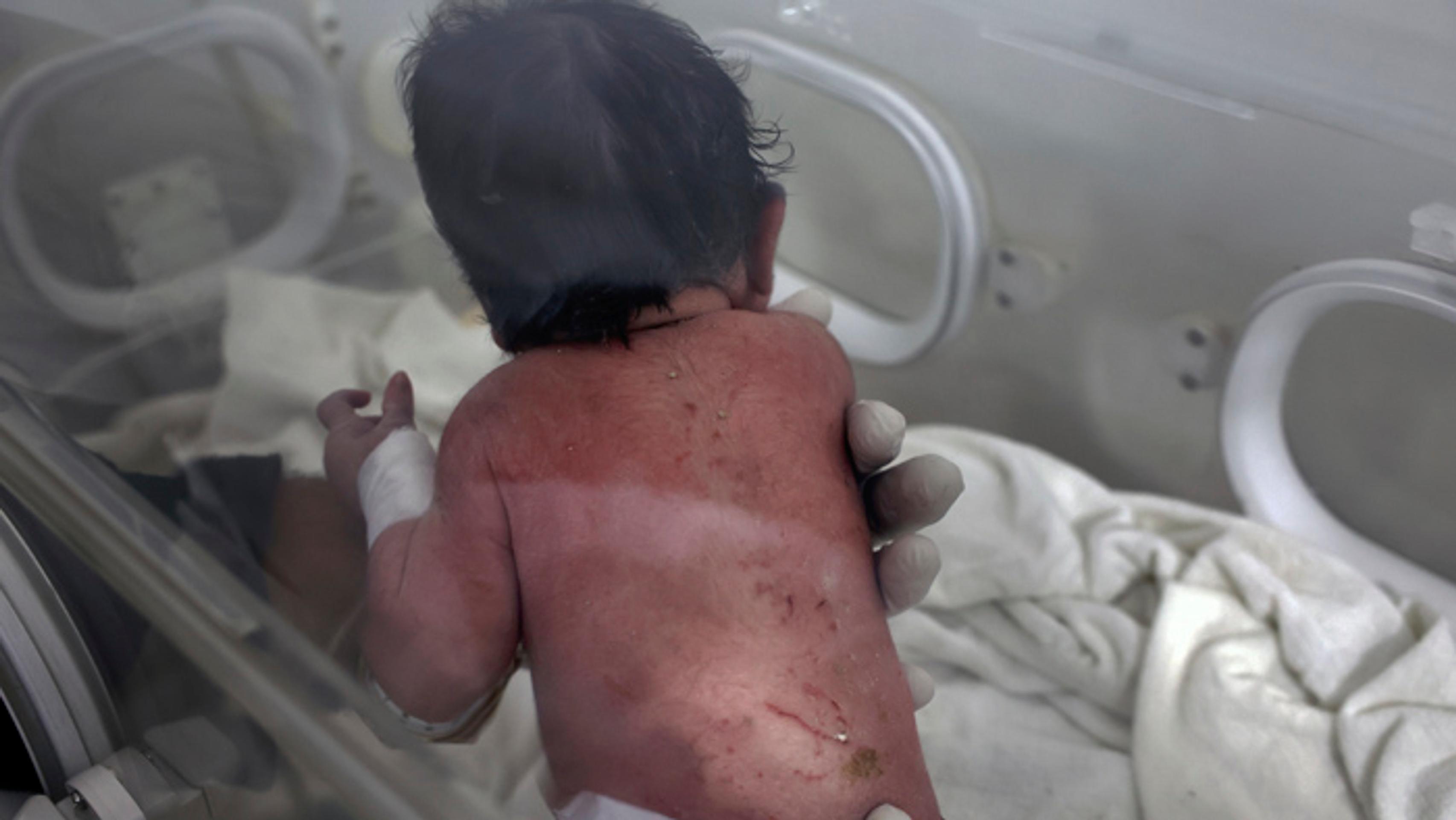 Dievčatko leží v inkubátore v detskej nemocnici v sýrskom meste Afrín.