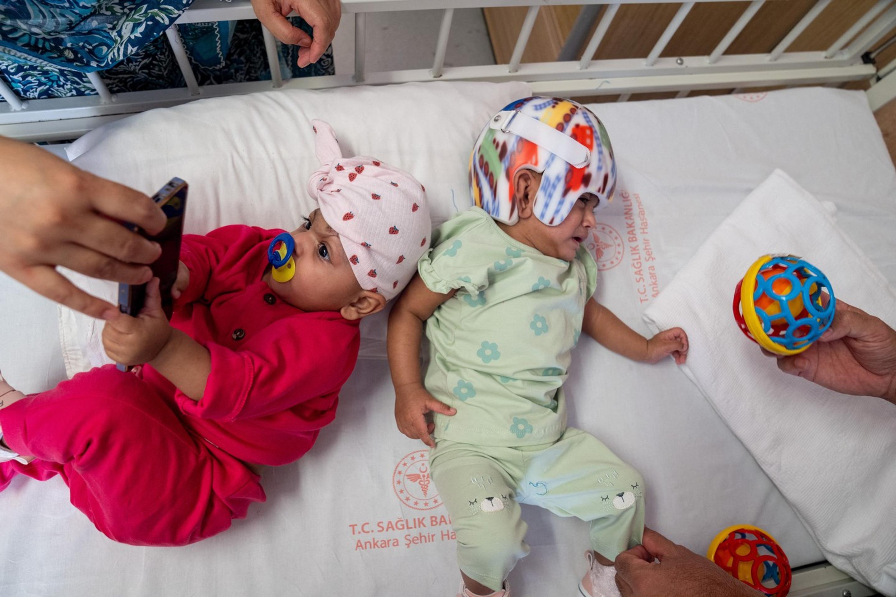 Dvojičky sa narodili so spojenými hlavami.